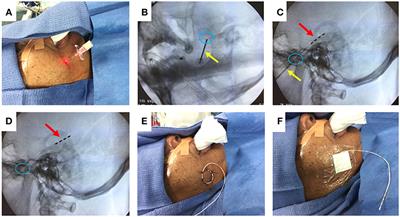 New Approaches to Studying Silent Mesial Temporal Lobe Seizures in Alzheimer's Disease